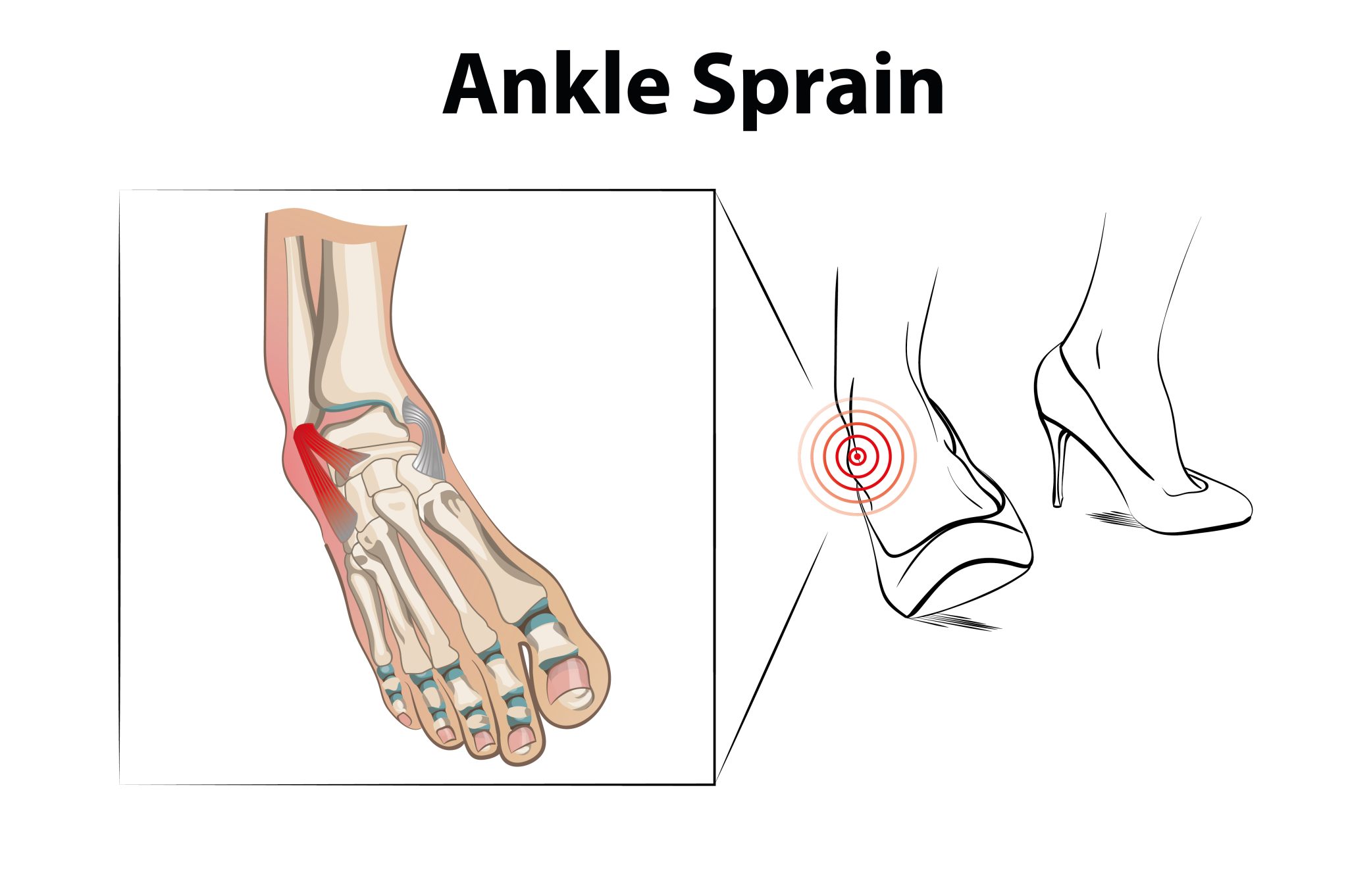 If Your Sprained Ankle Is Still Sore Months Later, Read This Now ...